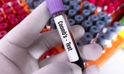 Indirect Coombs Test (Indirect Antiglobulin Test- IAT)